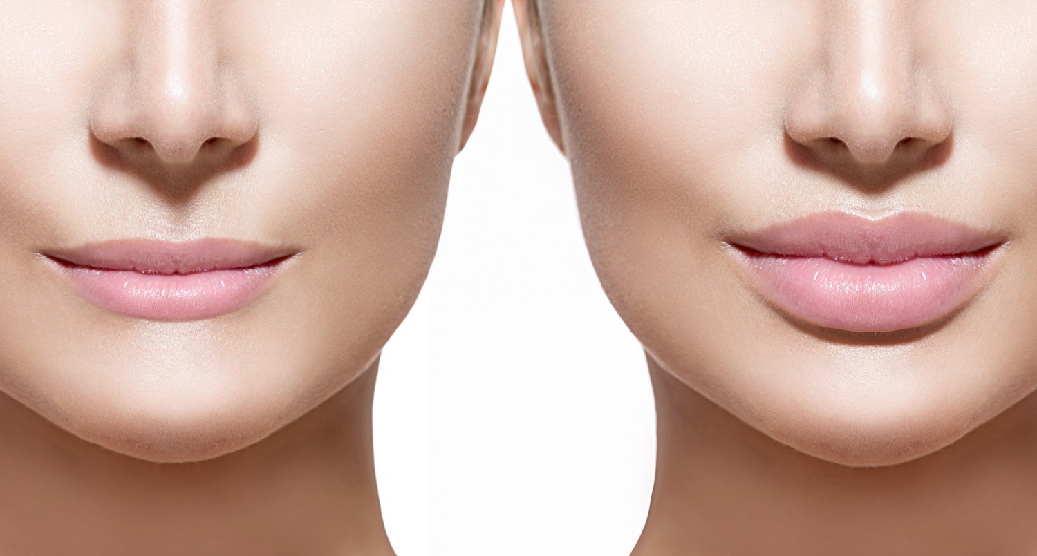 BM_Before and after lip filler injections. Lips closeup over white_80661881